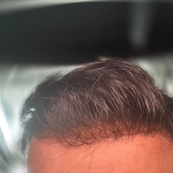 Protez Saçta Yanlış Ölçü Ve Kalitesiz Hizmet Deneyimi