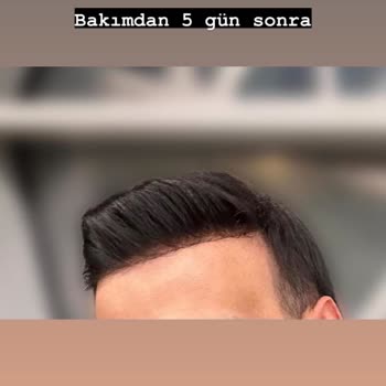 Protez Saçta Yanlış Ölçü Ve Kalitesiz Hizmet Deneyimi