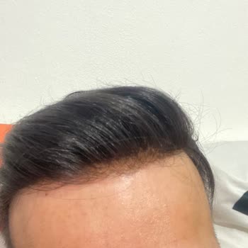 Protez Saçta Yanlış Ölçü Ve Kalitesiz Hizmet Deneyimi