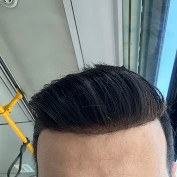 Protez Saçta Yanlış Ölçü Ve Kalitesiz Hizmet Deneyimi