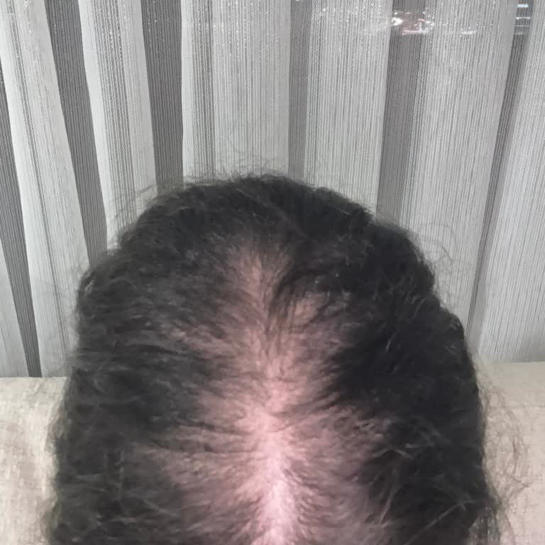 Mikro Kaynak Sonrası Saç Kaybı Ve Memnuniyetsizlik