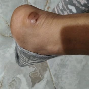 Deichmann Ayakkabı Ayağımda Yara Yaptı Mağaza Çözüm Sunmadı