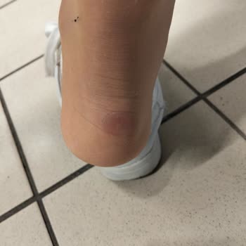 Deichmann Ayakkabı Ayağımda Yara Yaptı Mağaza Çözüm Sunmadı