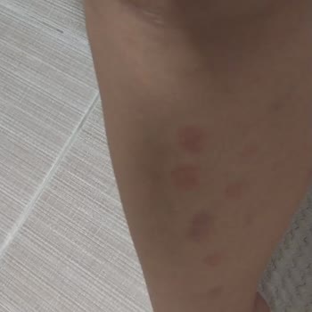 Lazer Epilasyon Sonrası Kalıcı Cilt Lekeleri Ve Mağduriyet Yaşadım