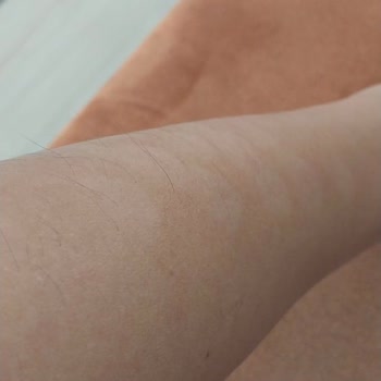 Lazer Epilasyon Sonrası Kalıcı Cilt Lekeleri Ve Mağduriyet Yaşadım