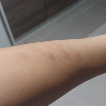 Lazer Epilasyon Sonrası Kalıcı Cilt Lekeleri Ve Mağduriyet Yaşadım