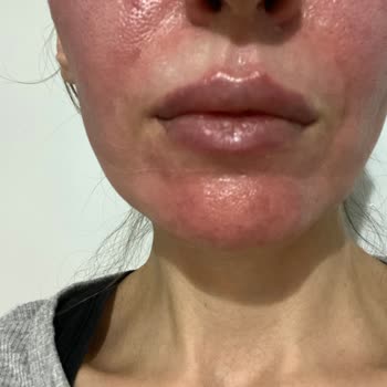 Hametan Krem Yüzümde Şiddetli Yanma Ve Cilt Hasarına Neden Oldu