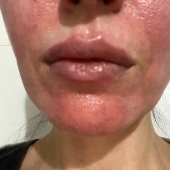 Hametan Krem Yüzümde Şiddetli Yanma Ve Cilt Hasarına Neden Oldu