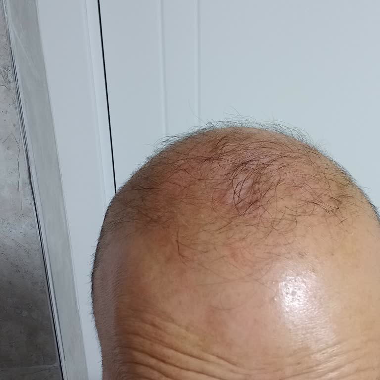 İstanbul Hair Center Saç Ekimi Sonrası Mağduriyet Ve İkinci Ekim Hakkı Sorunu