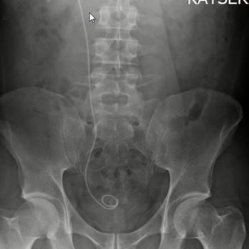 Böbrek Taşı Ameliyatı Sonrası Taşların Tamamen Alınmaması Nedeniyle Devam Eden Ağrılar Ve Mağduriyet