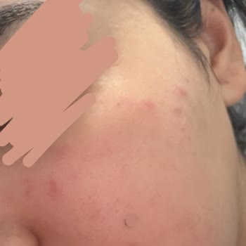 Peeling Gel Sonrası Yüzümde Yanma Ve Acil Çözüm Arayışı