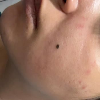 Peeling Gel Sonrası Yüzümde Yanma Ve Acil Çözüm Arayışı