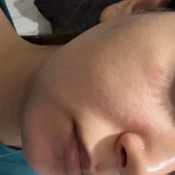 Peeling Gel Sonrası Yüzümde Yanma Ve Acil Çözüm Arayışı