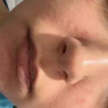 Peeling Gel Sonrası Yüzümde Yanma Ve Acil Çözüm Arayışı