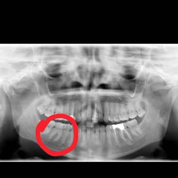 Özensiz Diş Dolgusu Sonrası Diş Kaybı Ve Mağduriyet