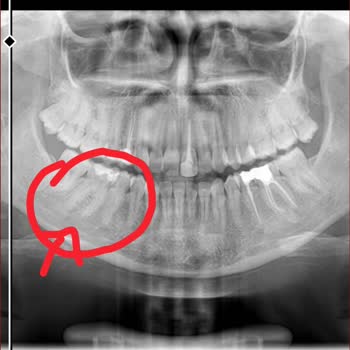 Özensiz Diş Dolgusu Sonrası Diş Kaybı Ve Mağduriyet