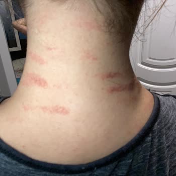 Lazer Epilasyon Sonrası Ciddi Yanıklar Ve Eksik Ücret İadesi Mağduriyeti