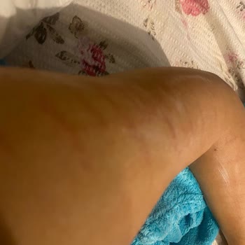 Lazer Epilasyon Sonrası Ciddi Yanıklar Ve Eksik Ücret İadesi Mağduriyeti