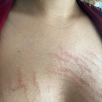 Lazer Epilasyon Sonrası Ciddi Yanıklar Ve Eksik Ücret İadesi Mağduriyeti