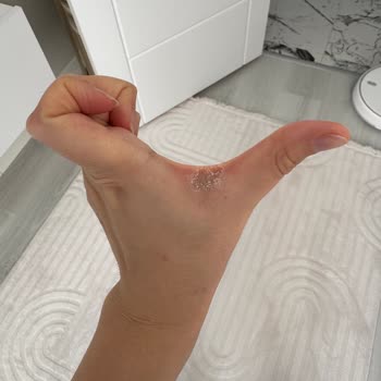Vanish Sıvı Deterjan Teması Sonrası Ciddi El Yaralanması Ve Uyarı Eksikliği