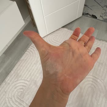 Vanish Sıvı Deterjan Teması Sonrası Ciddi El Yaralanması Ve Uyarı Eksikliği