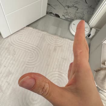 Vanish Sıvı Deterjan Teması Sonrası Ciddi El Yaralanması Ve Uyarı Eksikliği