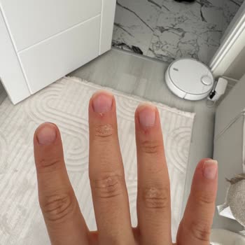 Vanish Sıvı Deterjan Teması Sonrası Ciddi El Yaralanması Ve Uyarı Eksikliği