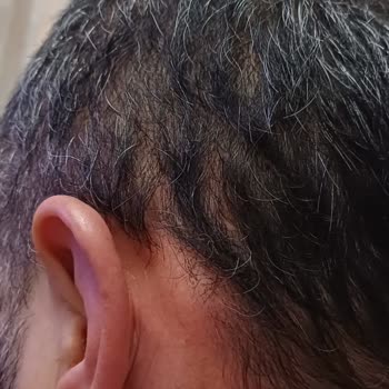 Saç Bakımında Yaşadığım Sağlık Sorunları Ve Yetersiz İletişim Mağduriyeti