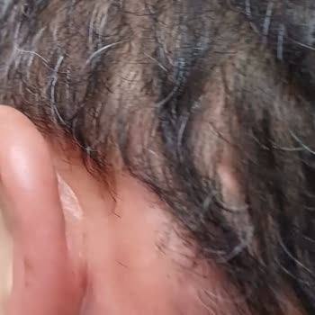 Saç Bakımında Yaşadığım Sağlık Sorunları Ve Yetersiz İletişim Mağduriyeti