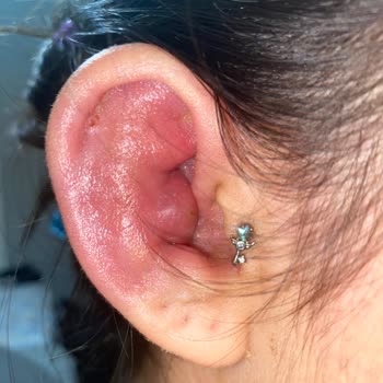 Bipiercing Yanlış Delim Sonrası Sağlık Sorunları ve İlgisiz Hizmet