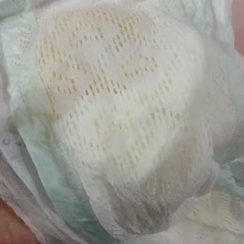 Prima Bebek Bezinde Topaklanma Ve Cilt Tahrişi Sorunu