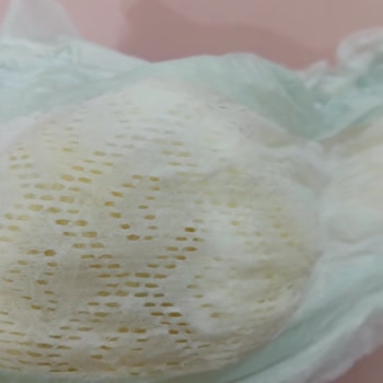 Prima Bebek Bezinde Topaklanma Ve Cilt Tahrişi Sorunu