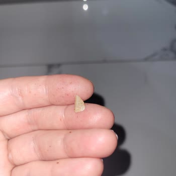 Eti Kakaolu Fındıklı Kekten Çıkan Yabancı Madde Dişimi Zedeledi