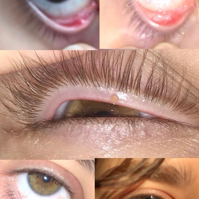 Loreal Paris Maskara Kullanımı Sonrası Göz Sağlığım Bozuldu, Acil Çözüm Bekliyorum