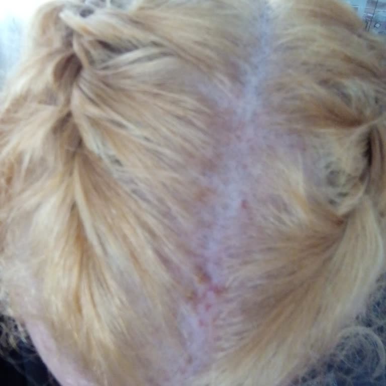 Saç Boyası Sonrası Dayanılmaz Yanma Ve Saç Derisinde Ciddi Zarar