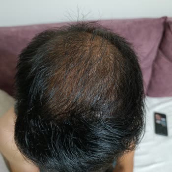 Saç Simülasyonu Sonrası Vaat Edilen Kalıcılık Sağlanmadı Ve Ücret İadesi Yapılmadı