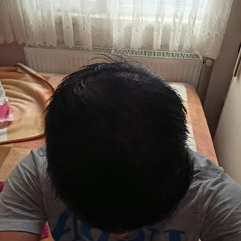 Saç Simülasyonu Sonrası Vaat Edilen Kalıcılık Sağlanmadı Ve Ücret İadesi Yapılmadı