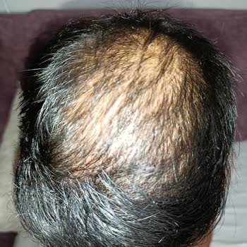 Saç Simülasyonu Sonrası Vaat Edilen Kalıcılık Sağlanmadı Ve Ücret İadesi Yapılmadı