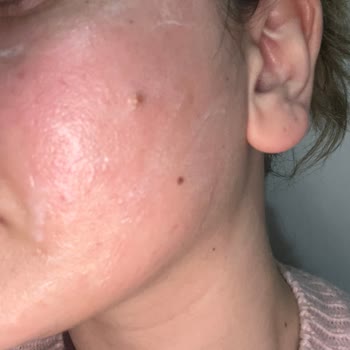 Claderm Kil Maskesi Cildimde Şiddetli Yanma Ve Kızarıklık Yaptı