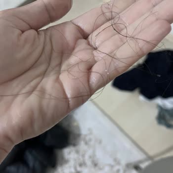 Anti Hair Loss Toniği Saç Dökülmemi Artırdı Çözüm Alamadım