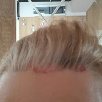 Saç Boyası Ciddi Deri Yanmasına Sebep Oldu!