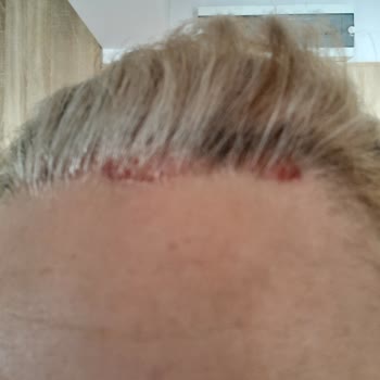 Saç Boyası Ciddi Deri Yanmasına Sebep Oldu!