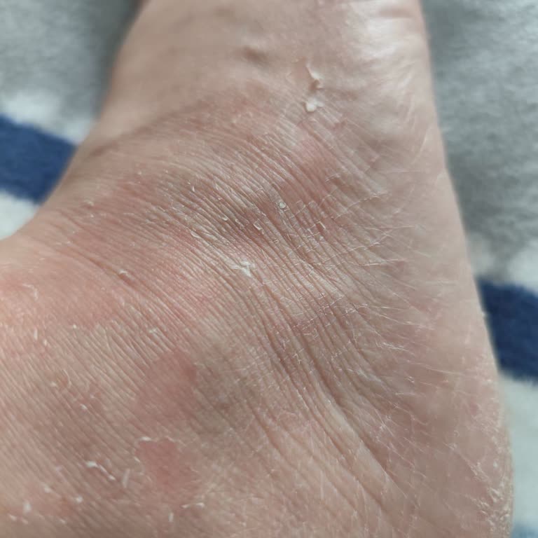 Ayak Maskesi Ciddi Alerjik Reaksiyona Sebep Oldu