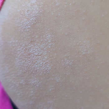 Mustela Stelatopia Krem Ciltte Kaşıntı Ve Kızarıklığa Sebep Oldu, Ücret İadesi Talebi