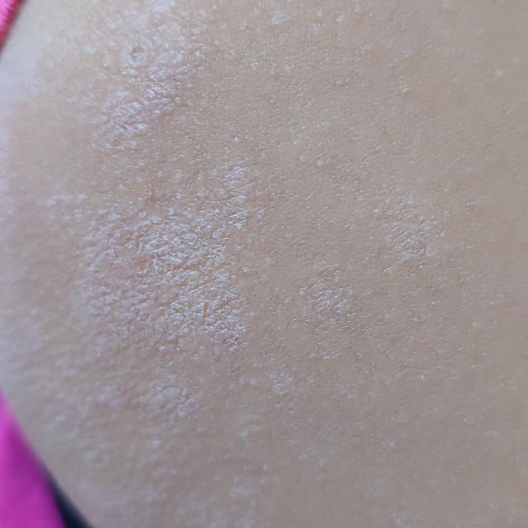 Mustela Stelatopia Krem Ciltte Kaşıntı Ve Kızarıklığa Sebep Oldu, Ücret İadesi Talebi