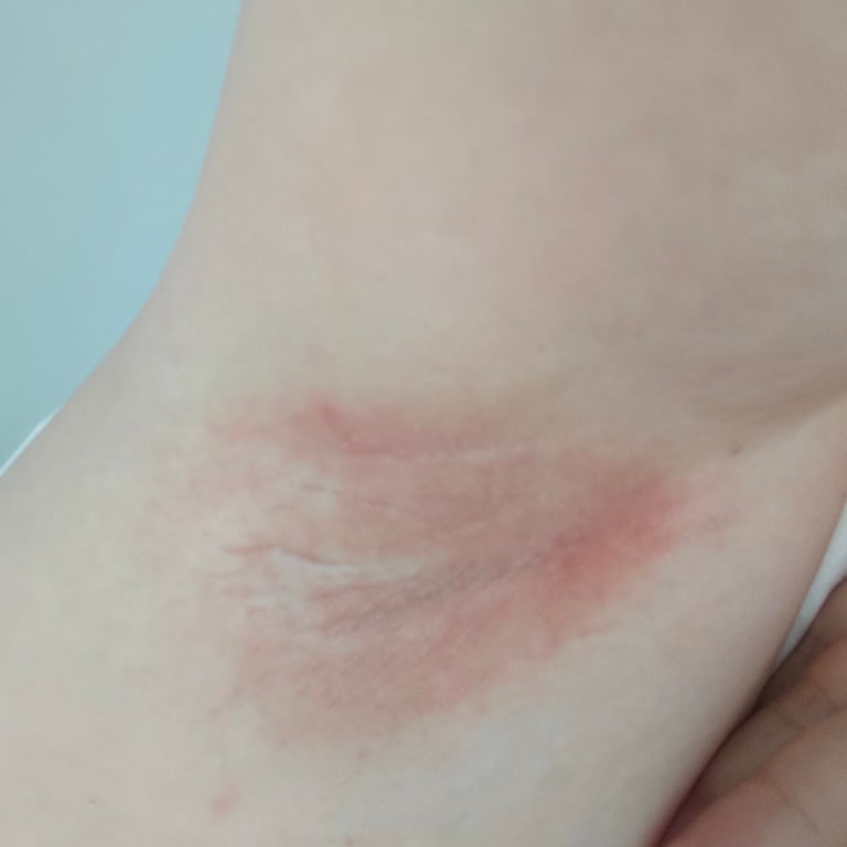 Alerjik Reaksiyon Nedeniyle Ürün İadesi Talebi