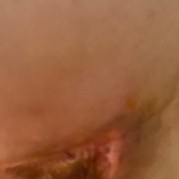 Boyun Liposuction Sonrası Kalıcı Hasar Ve Klinik Sorumluluk Reddi
