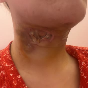 Boyun Liposuction Sonrası Kalıcı Hasar Ve Klinik Sorumluluk Reddi