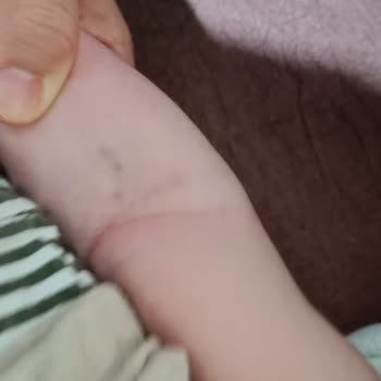 Bebek Hastaya Damar Yolu Açılamadı Personel Deneyimsizliği Mağduriyet Yaşattı