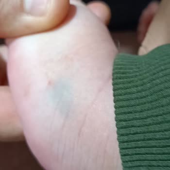 Bebek Hastaya Damar Yolu Açılamadı Personel Deneyimsizliği Mağduriyet Yaşattı